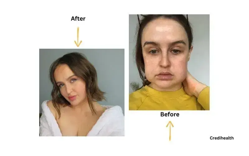 Before and After Buccal Fat Removal