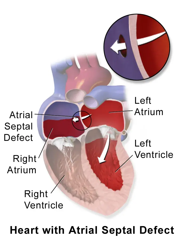 Atrial Septal Defect Explained