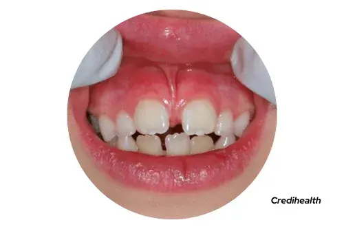 Frenectomy - how to fix a gap in teeth