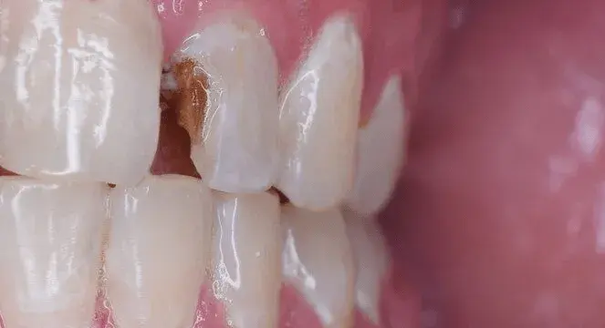 Dentin Decay