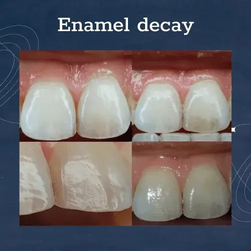 Enamel Decay