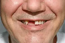 tooth loss