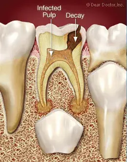 Tooth Pulp Infection