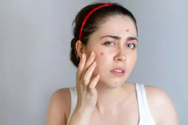 how to shrink a cystic pimple overnight