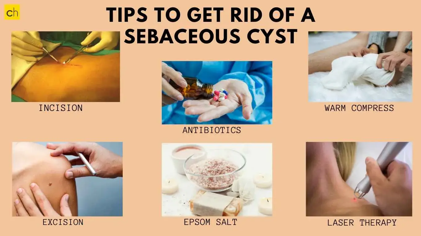 Tips To Get rid of a sebaceous cyst