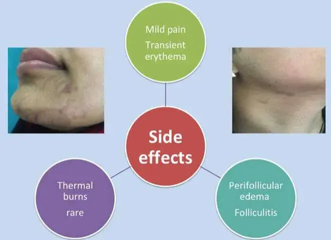 Side-effects of Laser Hair removal treatment