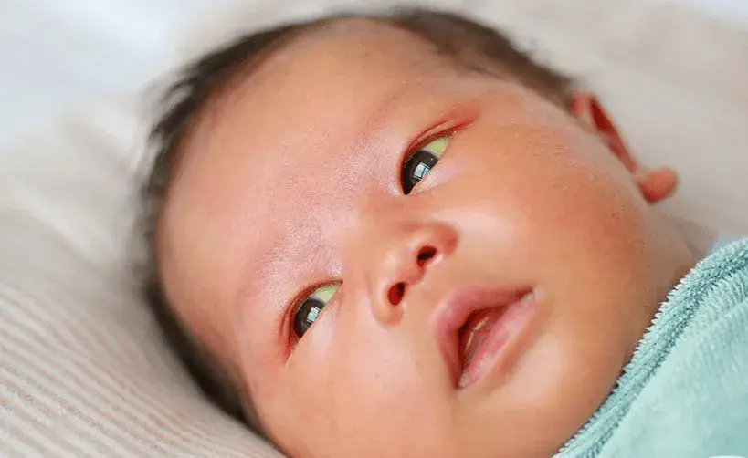 Yellow eyes in children