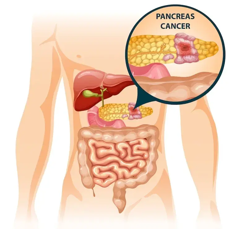 How I knew I had pancreatic cancer
