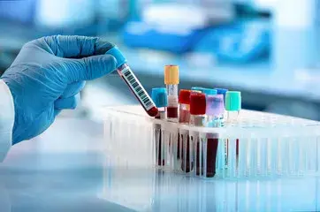What is the PSA level