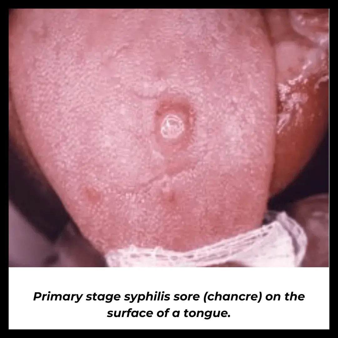 Primary stage syphilis sore (chancre) on the surface of a tongue. (1)