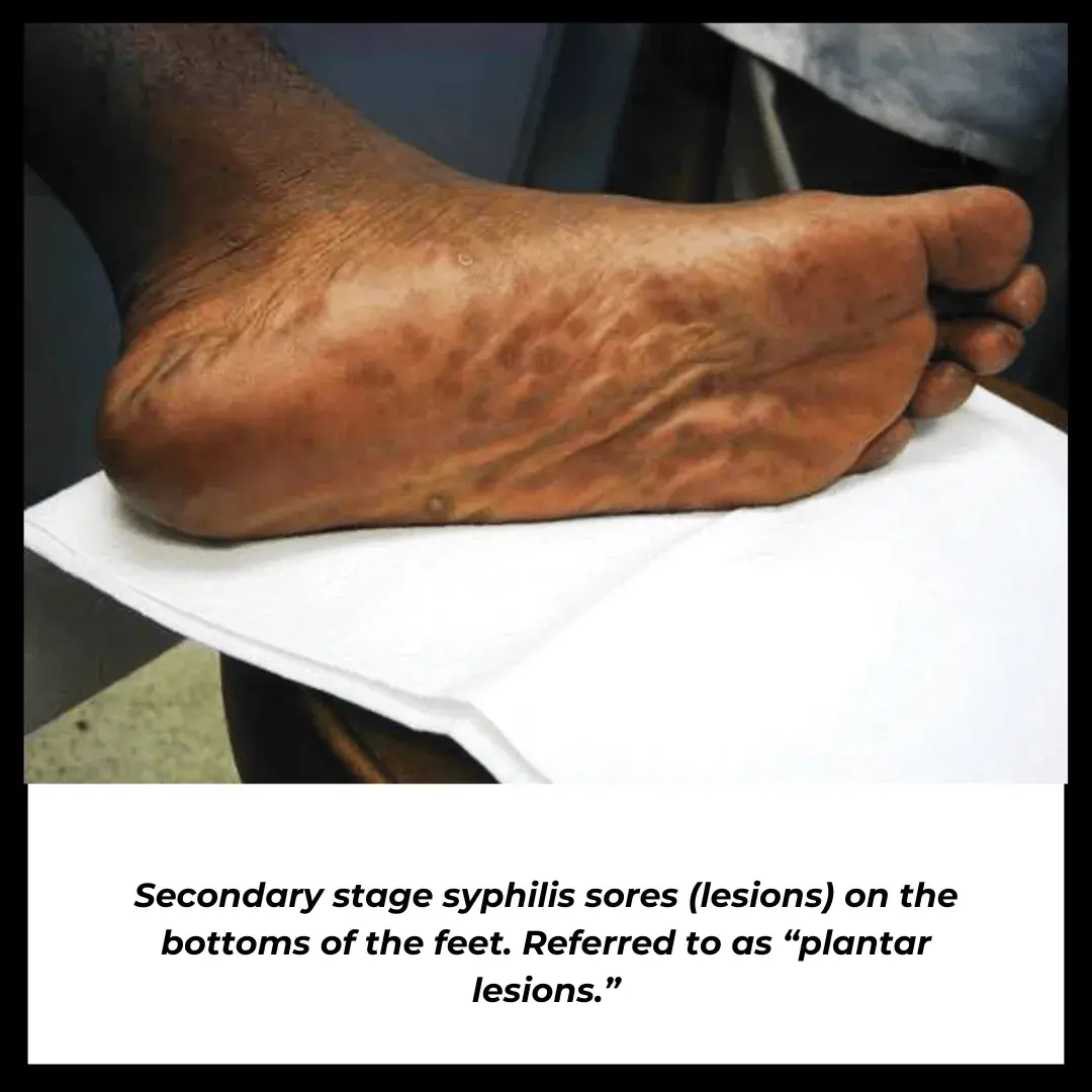 Secondary stage syphilis sores (lesions) on the bottoms of the feet. Referred to as