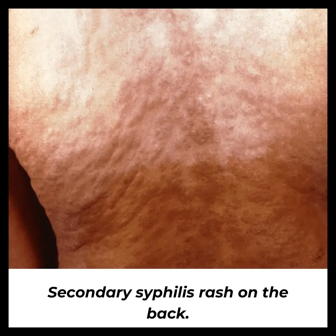 Secondary syphilis rash on the back.