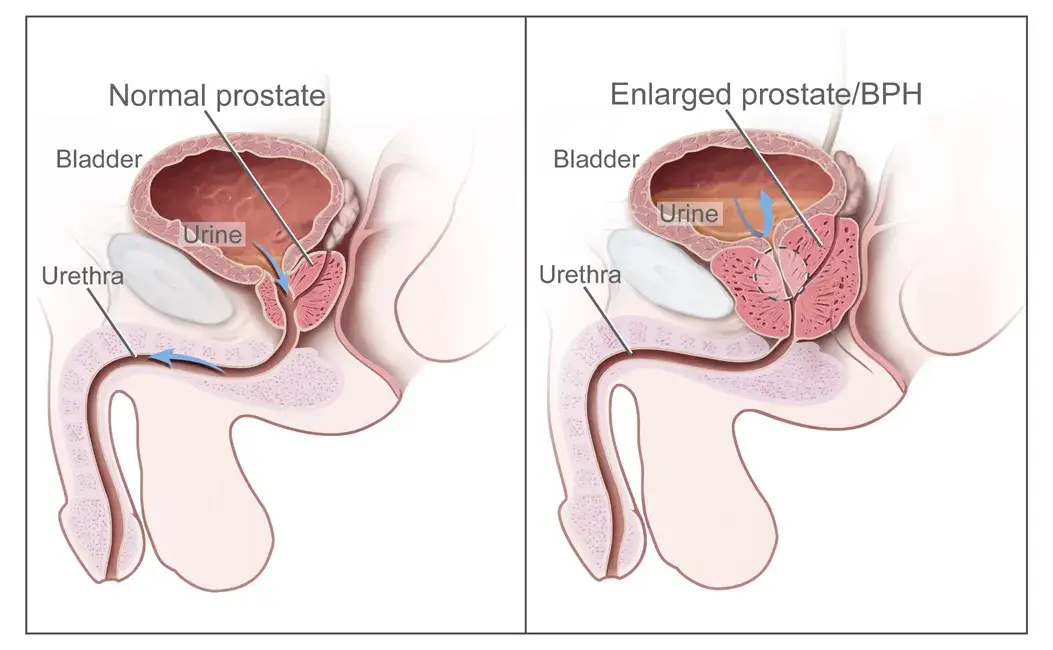 Benign Prostate Hyperplasia 