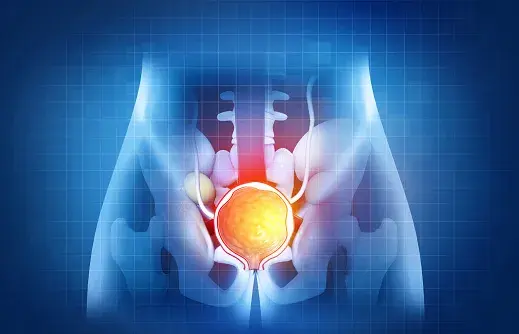 Benign Prostate Hyperplasia