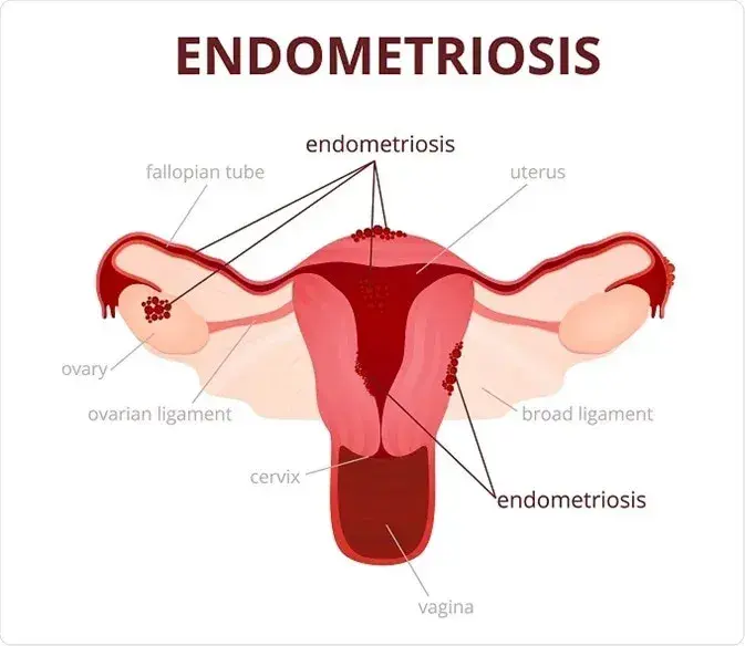 What is Endometriosis
