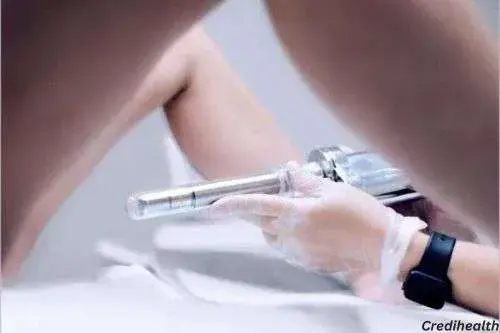 Vaginal Rejuvenation Laser Cost