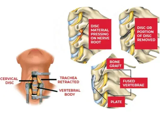 step-by-step procedure of Anterior Cervical Discectomy and Fusion