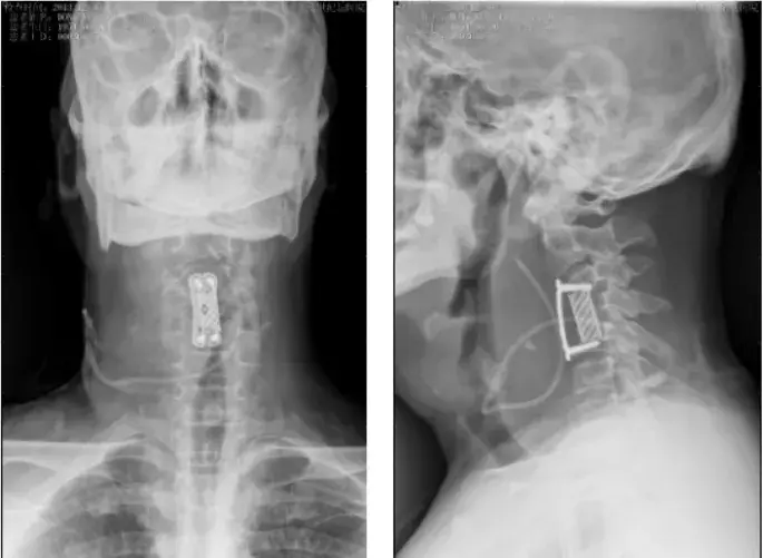 Anterior Cervical Discectomy and Fusion
