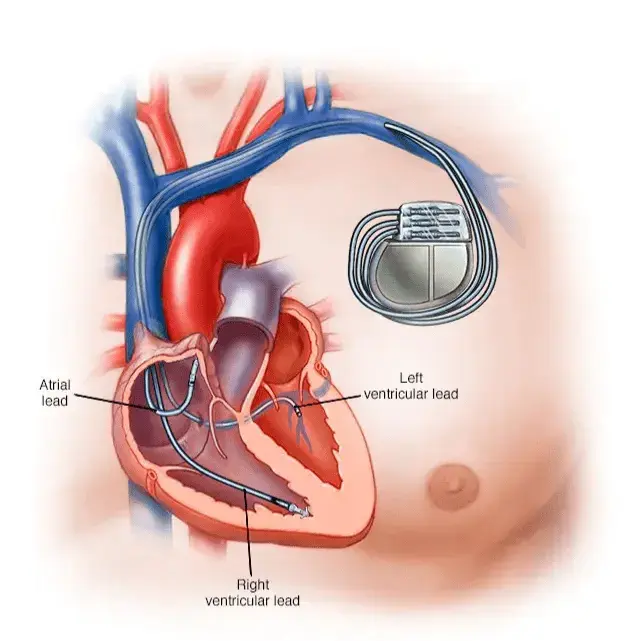 Pacemaker Implantation