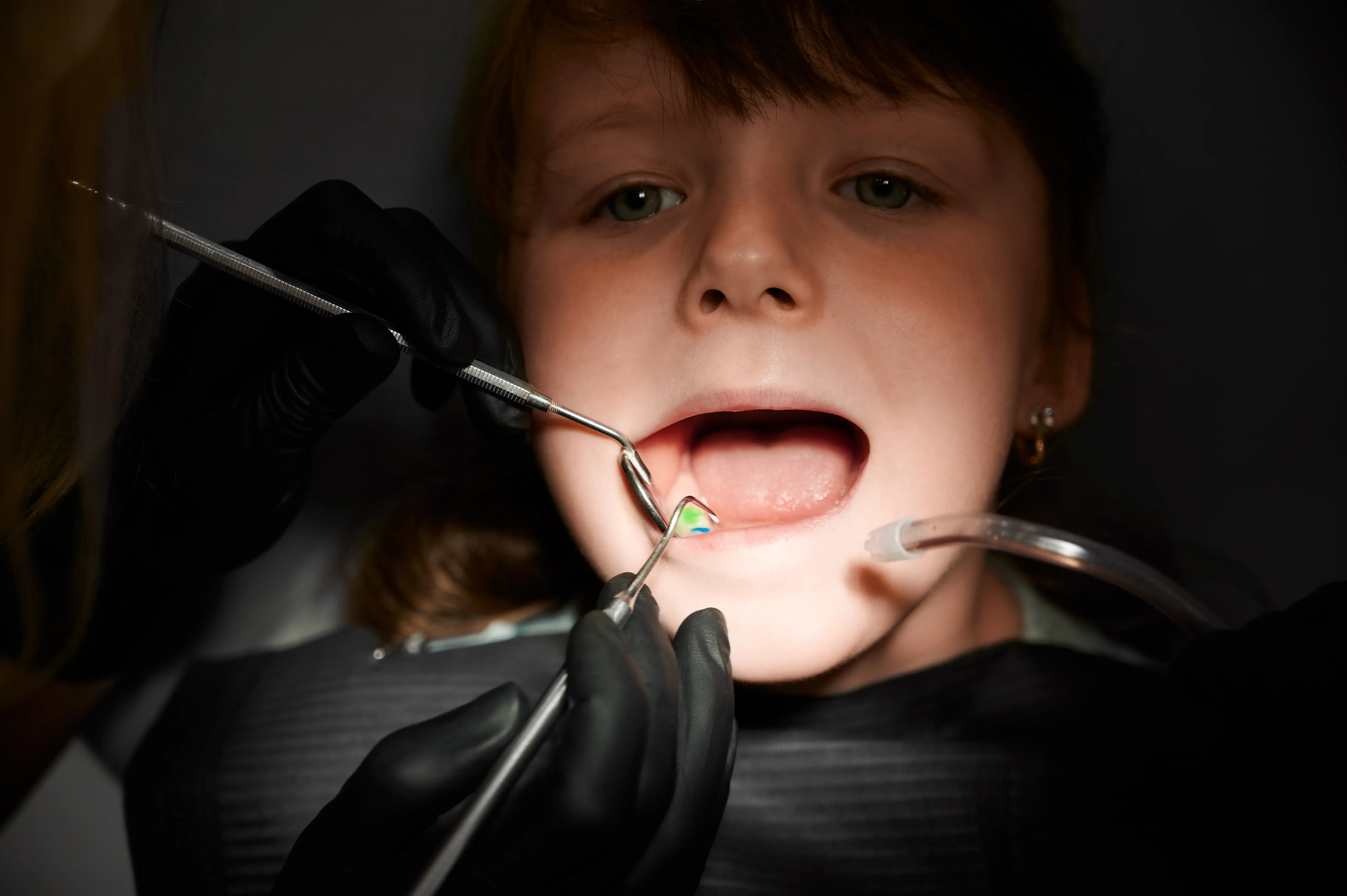 what does a cavity look like, what do cavities look like, how does cavity a look like