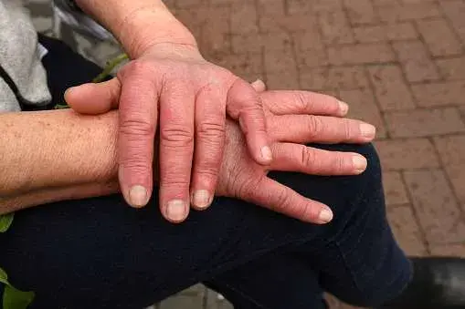 how to get rid of chilblains quickly