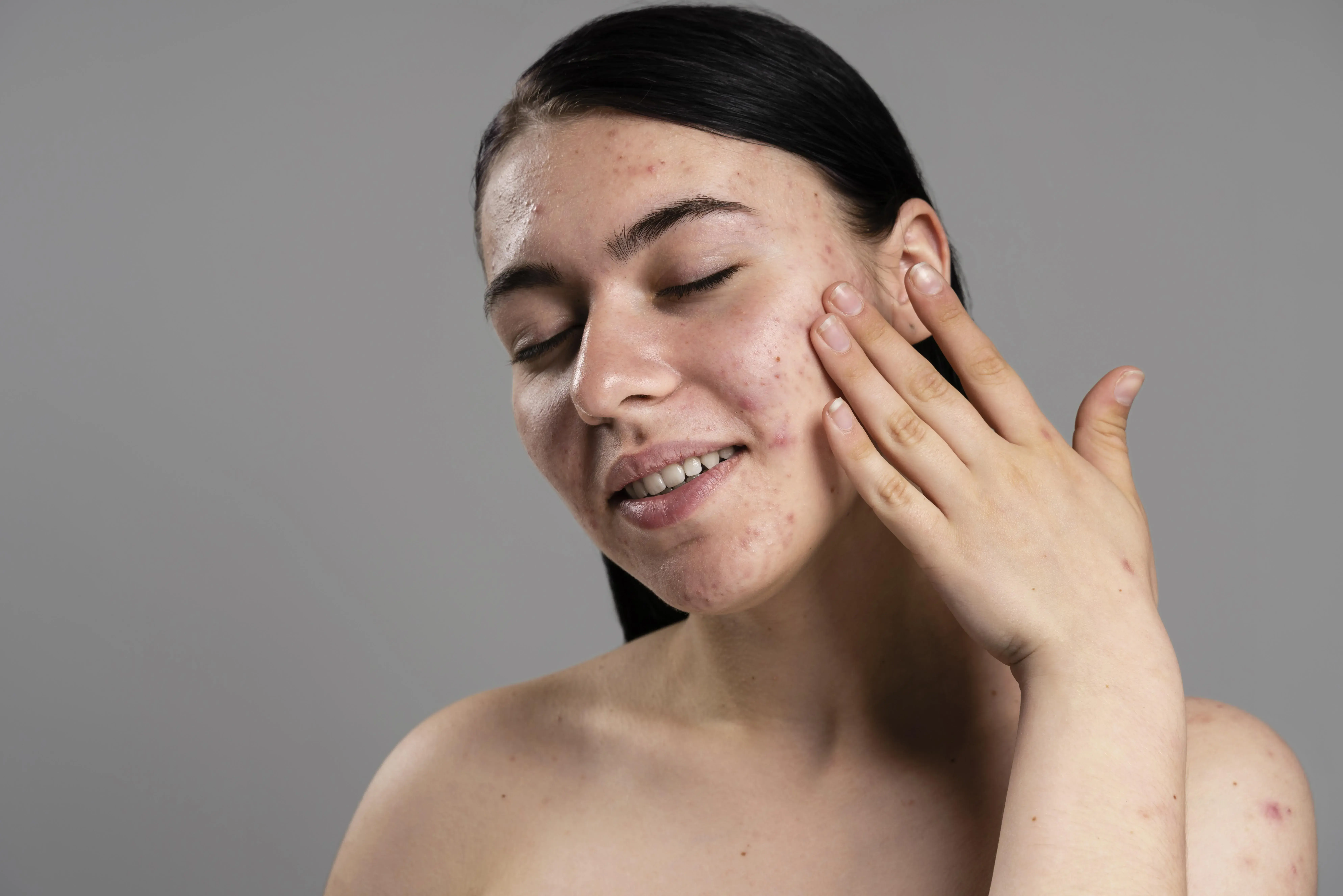 Use an over-the-counter acne treatment