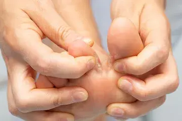 Fungal Skin Infections