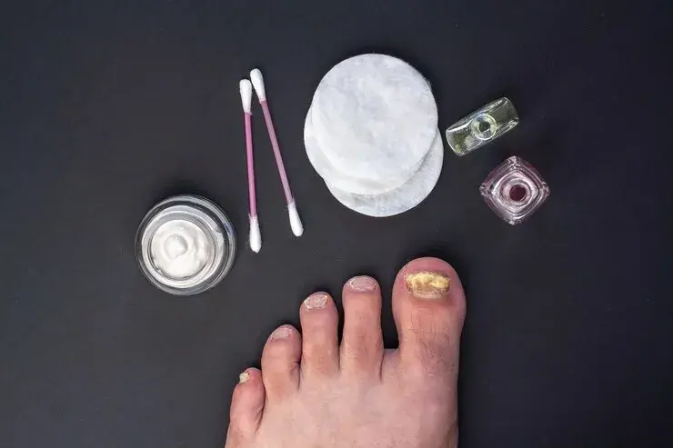 Home Remedies for Toenail Fungus