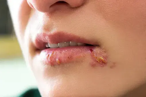 Chickenpox, herps