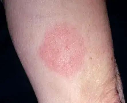 Lyme disease