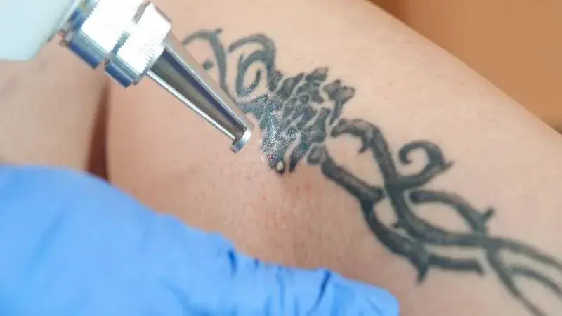 Tattoo Removal - Is Tattoo removal safe