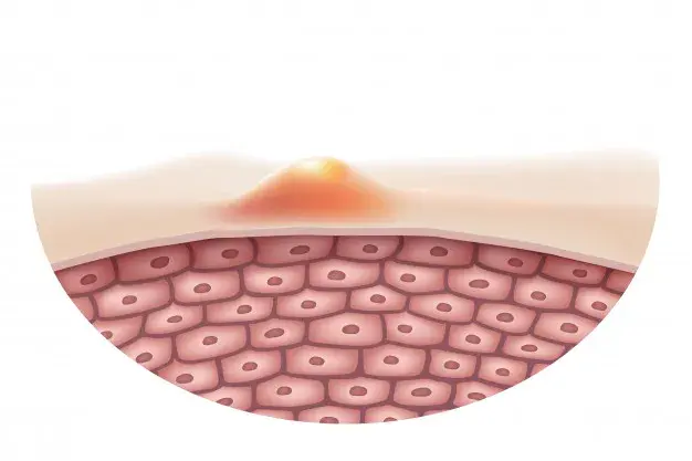 How to Remove Pimples, Pimple Treatment, How to get rid of Pimples, How to remove pimple marks, Home remedies for pimples