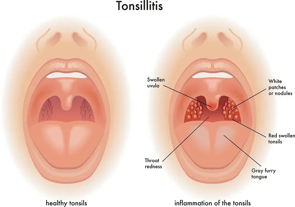 Tonsilitis