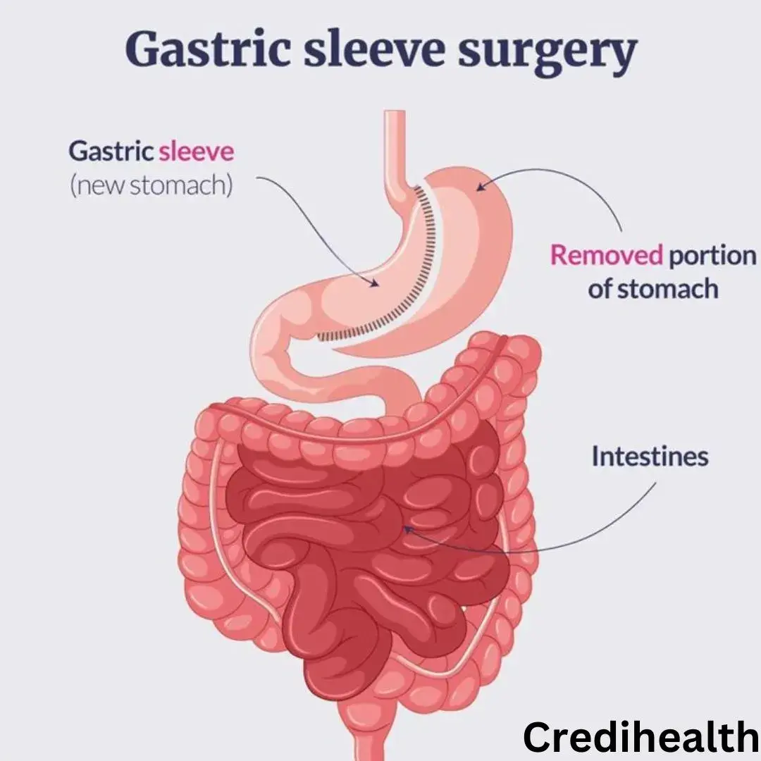 What is Gastric Sleeve Surgery