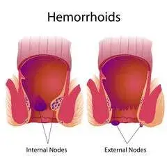 Causes of Hemorrhoids