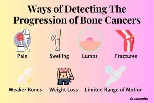 Ways of Detecting The Progression of Bone Cancers - how long can you have bone cancer without knowing