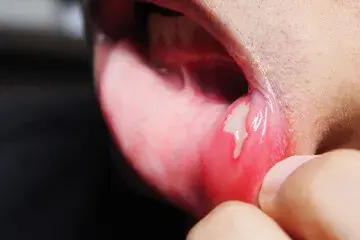 how to get rid of canker sores fast