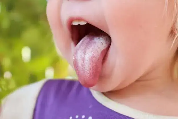 canker sore on the tongue, sore canker home remedy