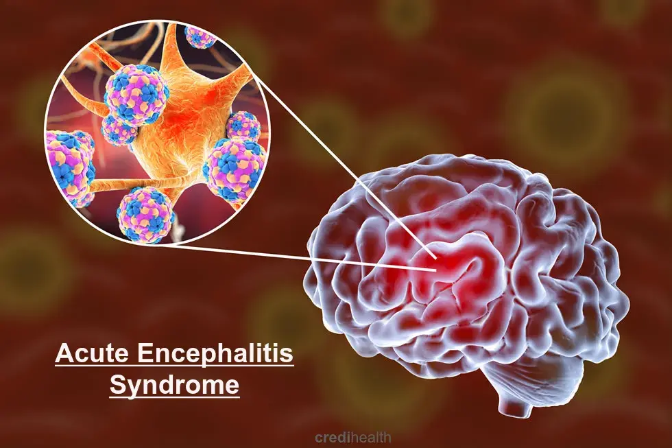 Acute Encephalitis Syndrome
