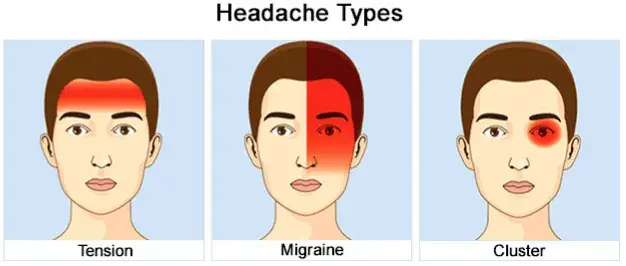 migraine