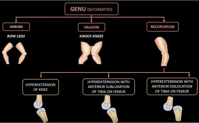 Types of Genu Recurvatum