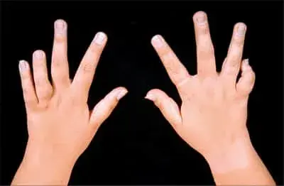 Juvenile Idiopathic Arthritis