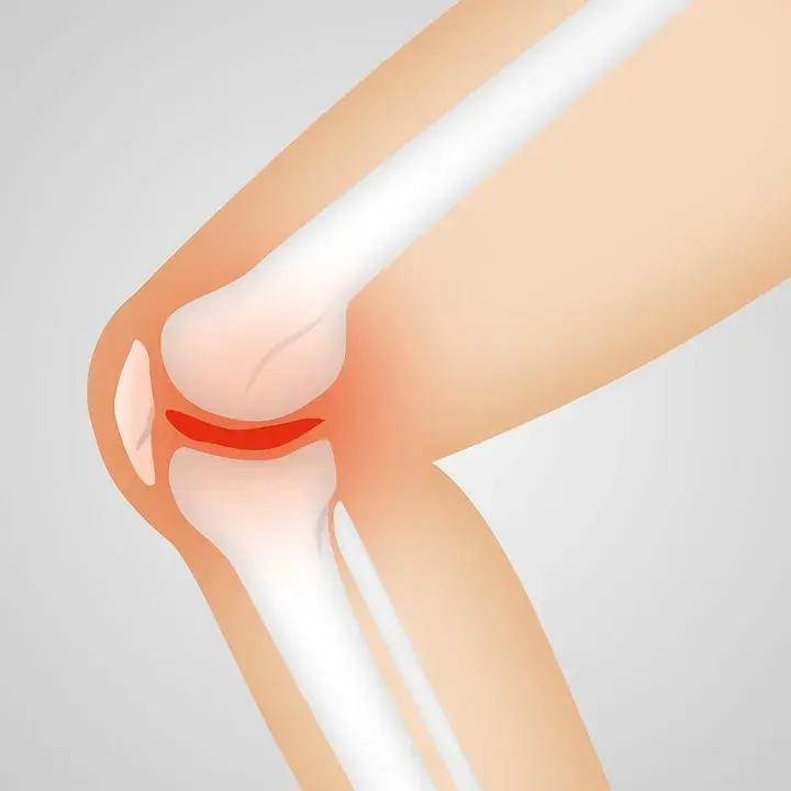 Osteoarthritis And Rheumatoid Arthritis