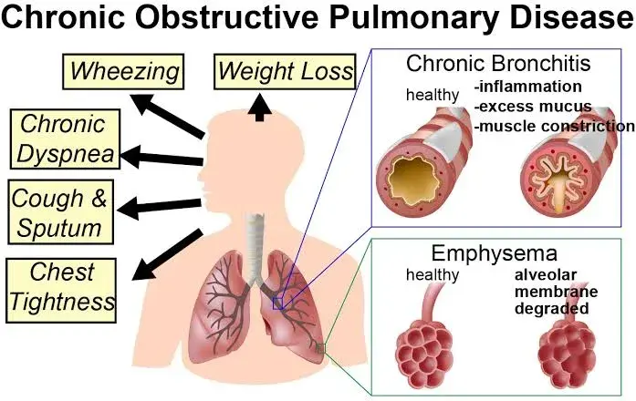 COPD, World COPD Day 2019, World COPD Day