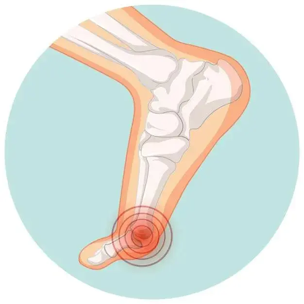 immediate gout pain relief