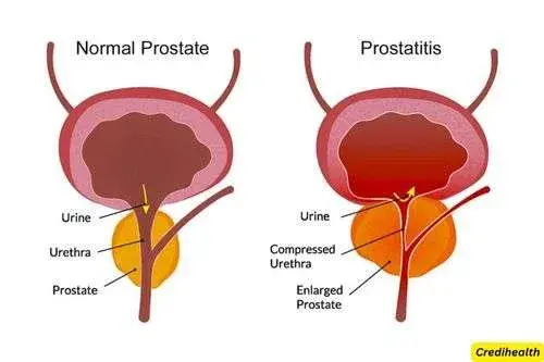 Pain in the Prostate (Prostatitis)