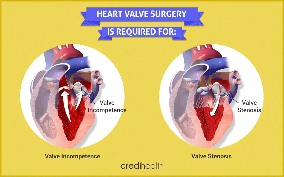 heart valve surgery