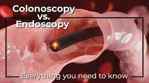 Endoscopy vs colonoscopy