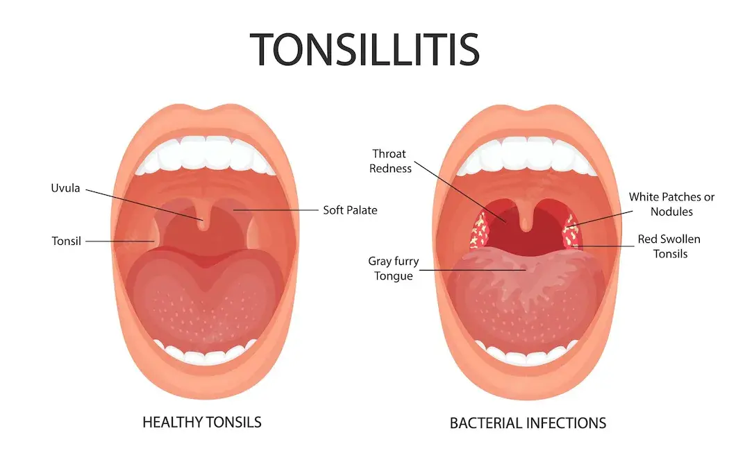 white stuff on tonsils