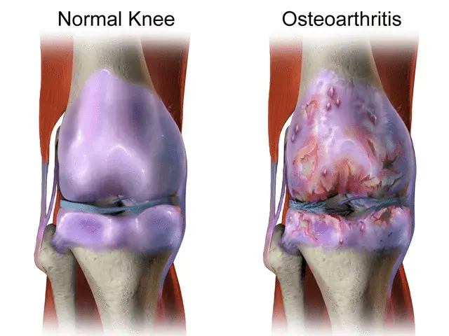 Normal Vs Arthritic Knee